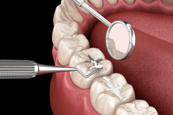 tooth-sensitivity-treatment-thangams-dental-clinic