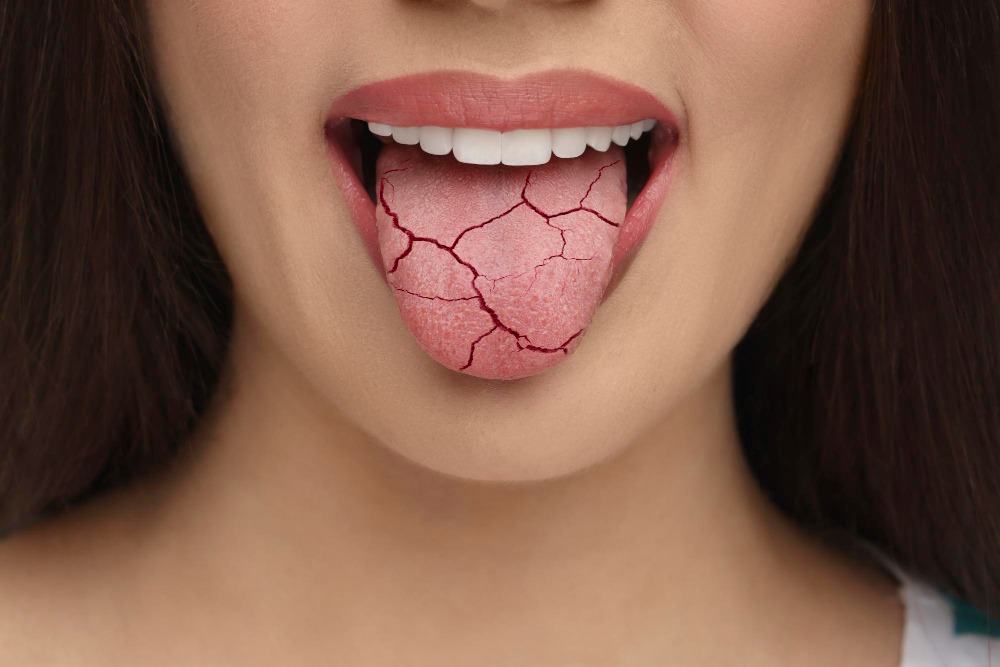 dry-mouth-symptoms-chennai-thangams-dental-clinic