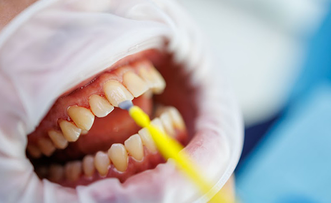 Denture fabrication