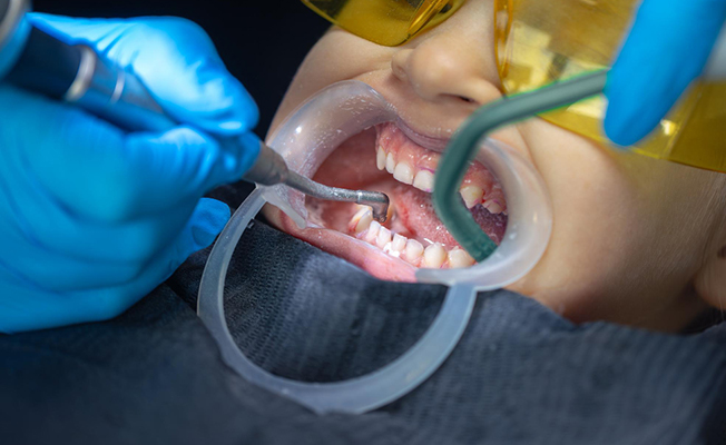 Denture fitting