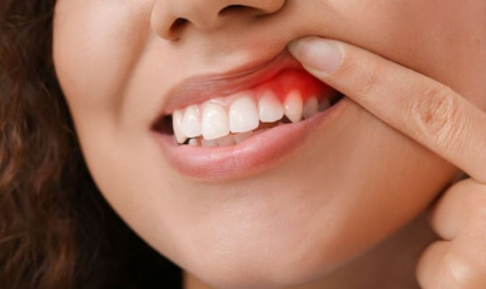 gum-disease-treatment-chennai