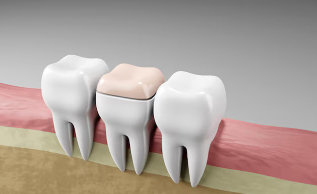Denture fitting